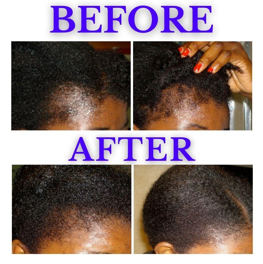 Thinning Hair Solutions: How to Fix Thinning Hair Naturally (Proven Methods That Actually Work)